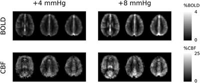 Graded Hypercapnia-Calibrated BOLD: Beyond the Iso-metabolic Hypercapnic Assumption